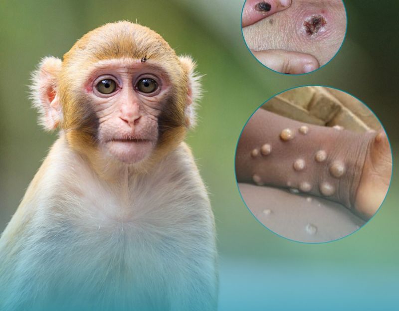 Bộ Y tế: Tiếp tục chủ động triển khai các giải pháp phòng, chống dịch đậu mùa khỉ trong thời gian tới