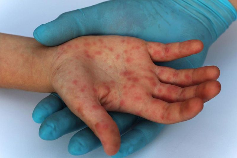 Các nốt phát ban do bệnh Đậu mùa khỉ thường xuất hiện nhiều ở lòng bàn tay