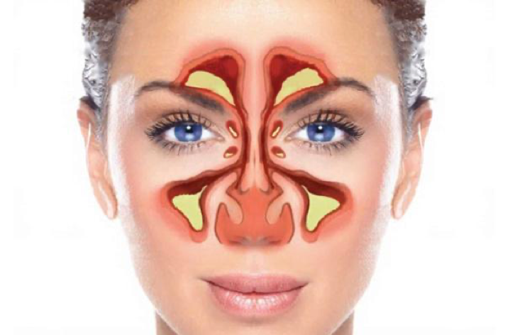Viêm xoang gây đau nhức vùng mũi, mặt, trán