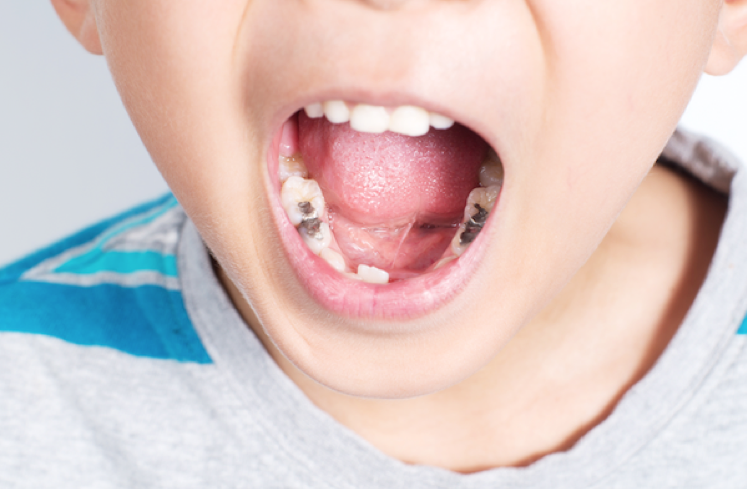 Sâu răng ở trẻ em chính là nguyên nhân hàng đầu gây tình trạng trẻ bị hôi miệng