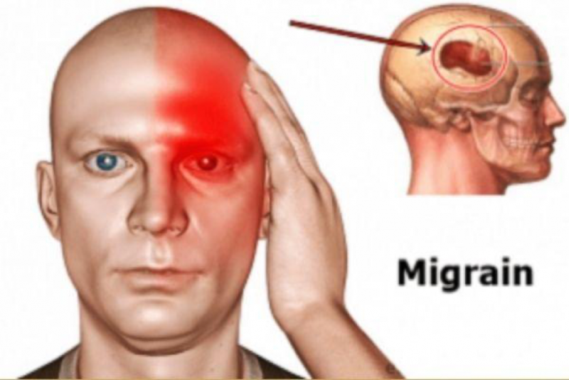 Bệnh đau nửa đầu Migraine gây ra đau nửa đầu vai gáy