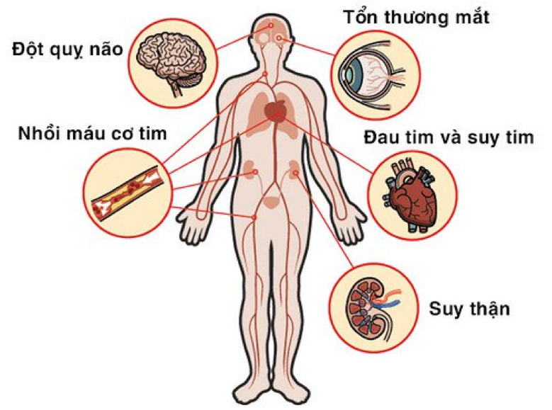 Huyết áp không ổn định gây tổn thương trên mọi cơ quan