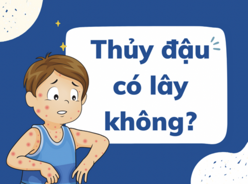 Thủy đậu có lây không và giải pháp từ bộ đôi gel & cốm Subạc