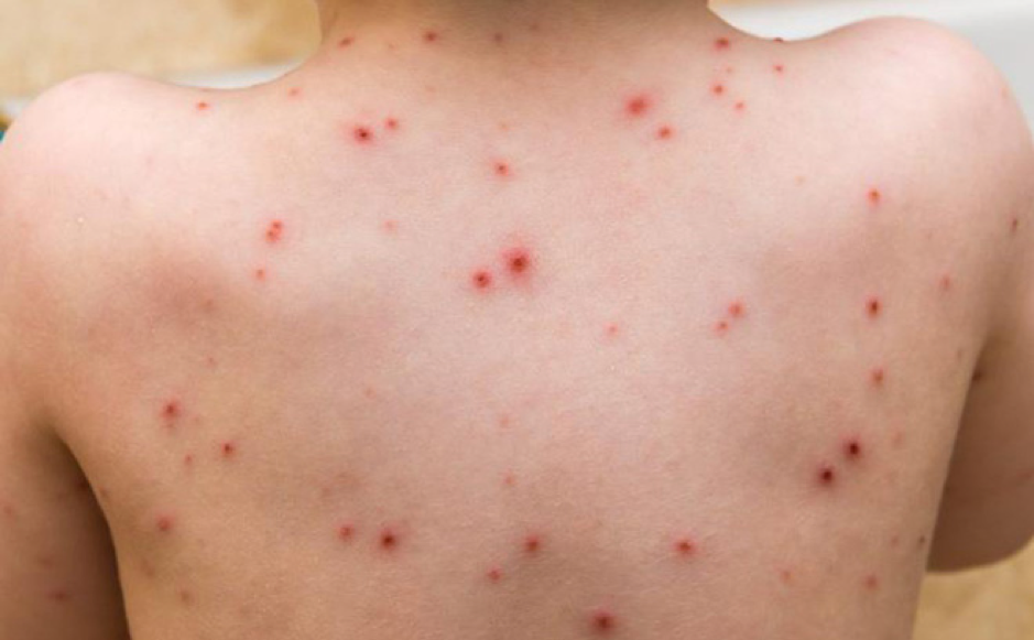 Bệnh thủy đậu dễ dàng lây nhiễm qua tiếp xúc trực tiếp hoặc dùng chung đồ vật Bệnh thủy đậu dễ dàng lây nhiễm qua tiếp xúc trực tiếp hoặc dùng chung đồ vật