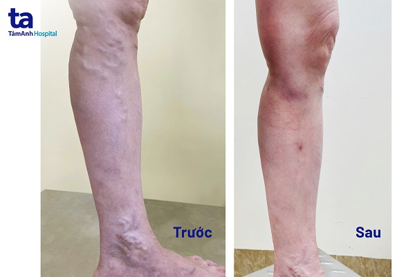 Hình ảnh chân người bệnh trước và sau khi điều trị suy giãn tĩnh mạch