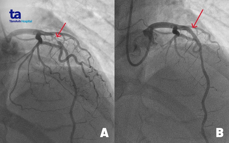 Hình ảnh động mạch liên thất trước (mạch máu chính nuôi tim) bị đứt do tắc nghẽn nặng (hình A) và sau khi được tái thông nhờ đặt stent kích thước lớn