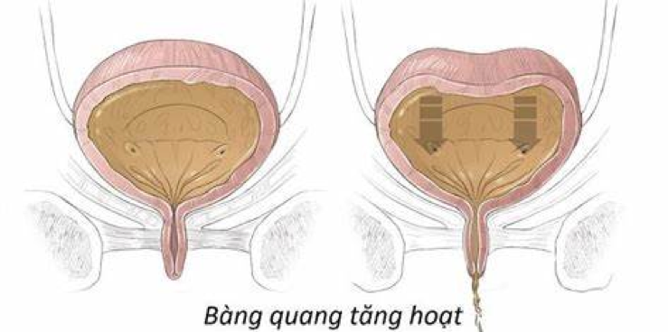 Bàng quang kích thích là nguyên nhân phổ biến gây tiểu nhiều lần Bàng quang kích thích là nguyên nhân phổ biến gây tiểu nhiều lần