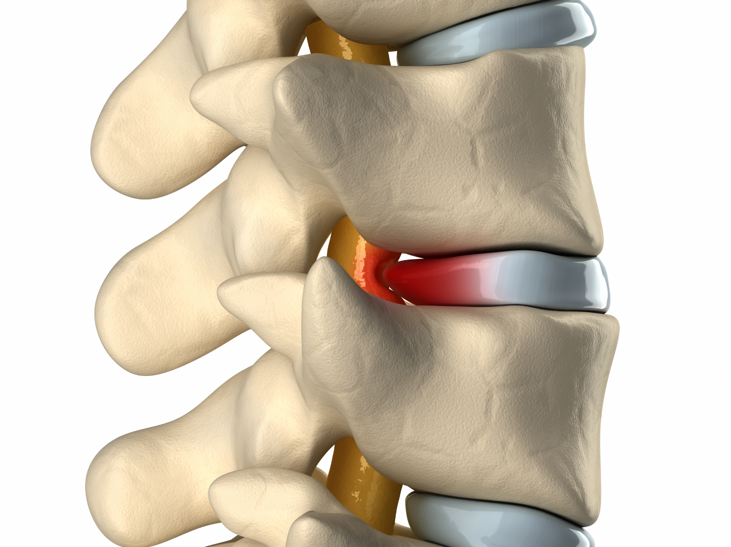 Đĩa đệm trượt khỏi vị trí chạm vào các dây thần kinh xung quanh gây nên cảm giác đau nhức cho người bệnh
