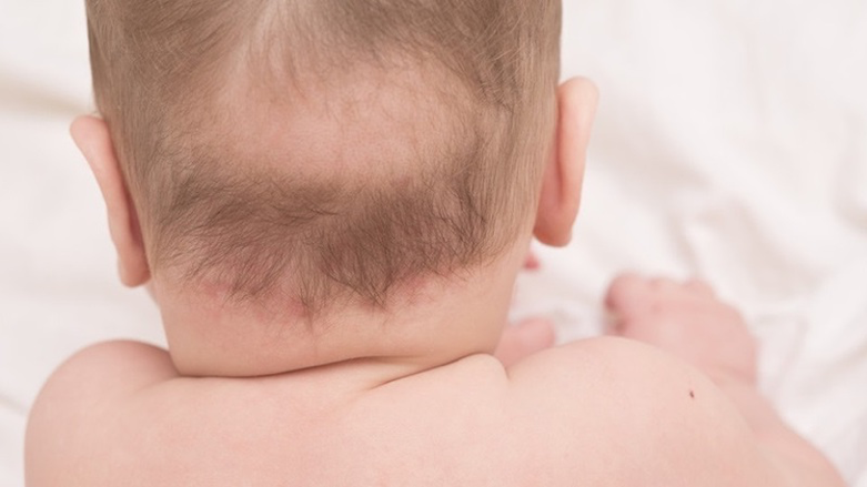 Trẻ thiếu vitamin D3 dẫn đến tình trạng bé rụng tóc vành khăn
