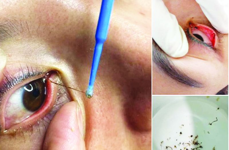 Thận trọng với dịch vụ “bắt sâu mắt” có nguy cơ bị hỏng mắt