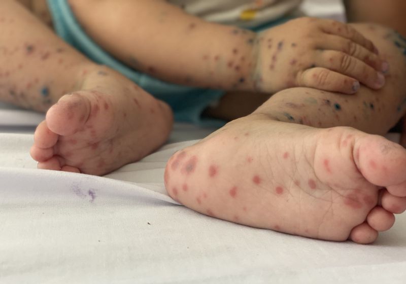 Bộ Y tế lập 7 đoàn kiểm tra, giám sát phòng chống bệnh tay chân miệng