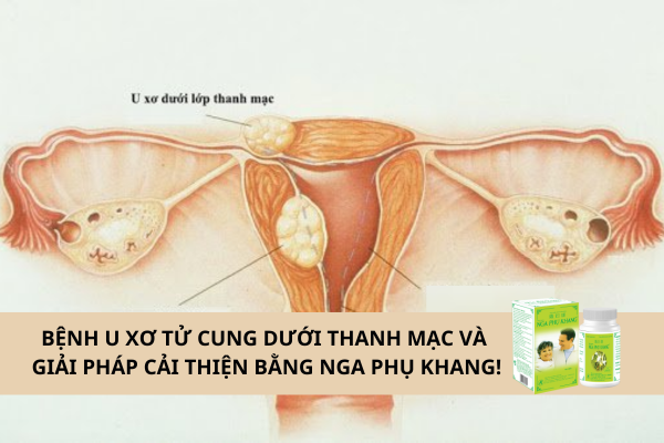  U xơ tử cung dưới thanh mạc và giải pháp cải thiện bằng Nga Phụ Khang