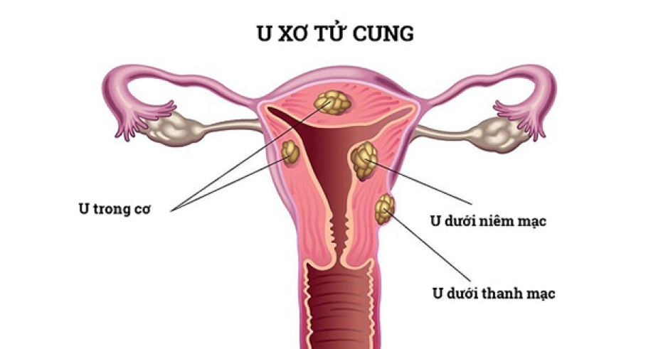 U xơ tử cung dưới thanh mạc thường gặp ở nữ giới trong độ tuổi sinh sản U xơ tử cung dưới thanh mạc thường gặp ở nữ giới trong độ tuổi sinh sản