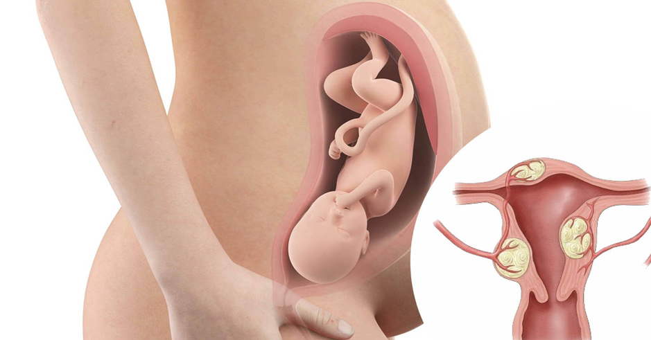 U xơ tử cung dưới thanh mạc có thể ảnh hưởng đến sức khỏe của phụ nữ mang thai U xơ tử cung dưới thanh mạc có thể ảnh hưởng đến sức khỏe của phụ nữ mang thai