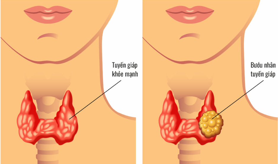 Phần lớn nhân tuyến giáp là lành tính