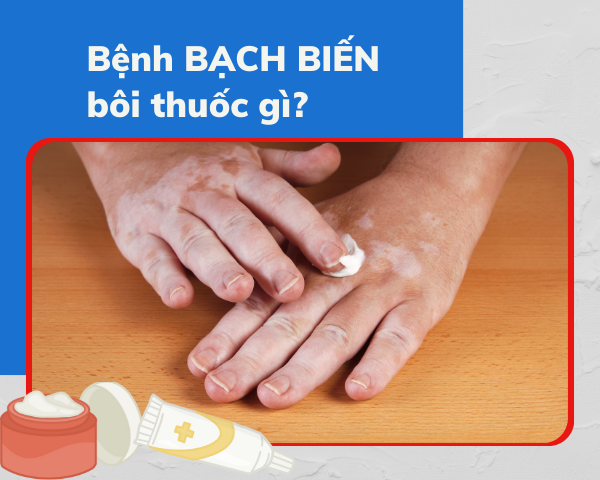 Bệnh bạch biến bôi thuốc gì và giải pháp từ Kim Miễn Khang