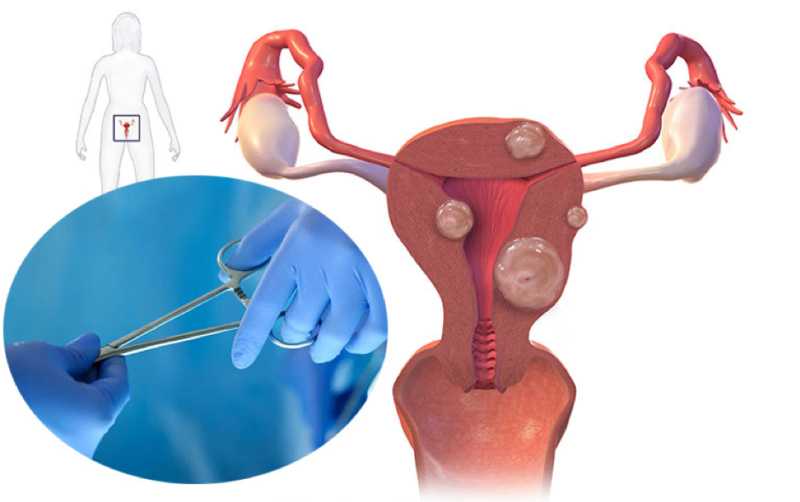 Phẫu thuật u xơ tử cung có thể tiềm ẩn nhiều biến chứng nguy hiểm