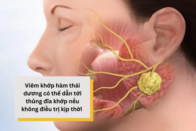 Viêm khớp hàm thái dương nổi hạch: Cách phát hiện và điều trị hiệu quả