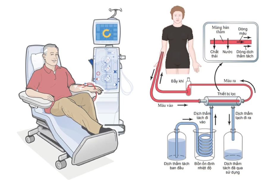Khi thận suy giảm chức năng nghiêm trọng, người bệnh sẽ được chỉ định chạy thận nhân tạo