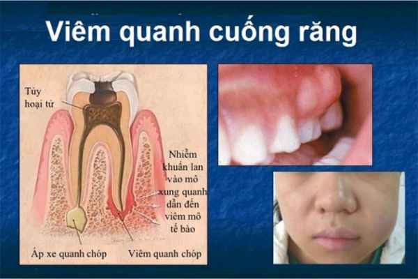 Đánh bay nỗi lo viêm quanh cuống răng bằng giải pháp thiên nhiên