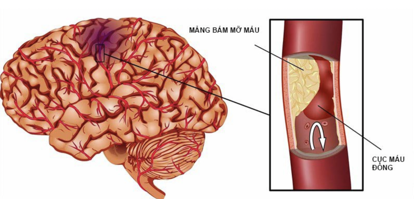 Xơ vữa động mạch gây cục máu đông làm tắc mạch máu não