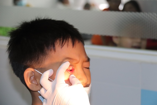 TP. Hồ Chí Minh: Đã xác định được tác nhân gây bệnh đau mắt đỏ