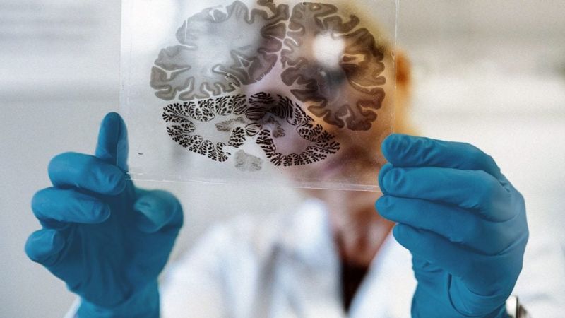 Kinh Vương Não Bộ - giải pháp mới giúp phục hồi di chứng teo não