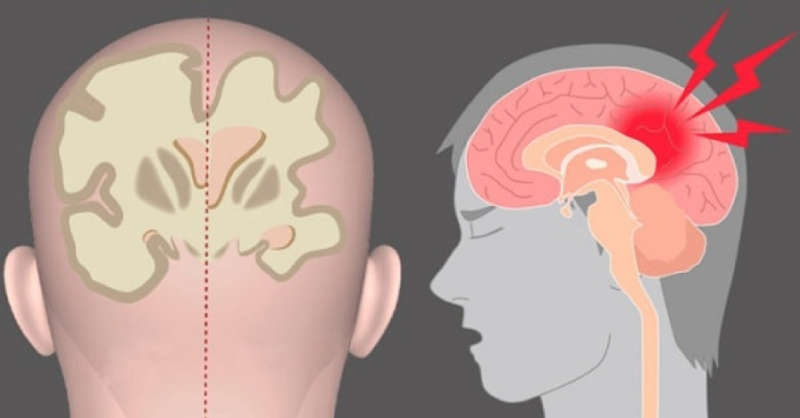Người bệnh teo não có thể mất kiểm soát hành vi gây nguy hiểm cho bản thân và người xung quanh