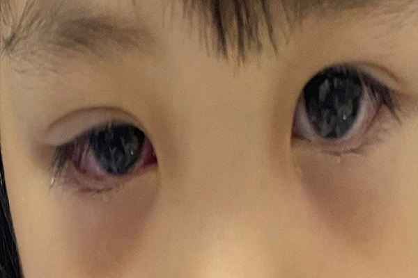 Dấu hiệu của bệnh đau mắt đỏ. (ảnh minh họa)