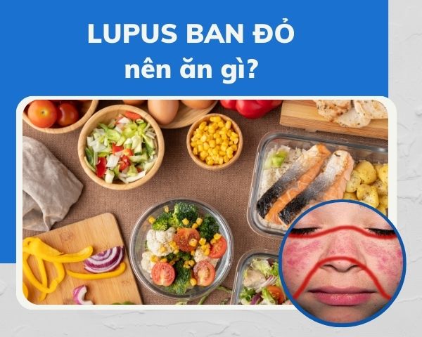 Bệnh lupus ban đỏ nên ăn gì? Uống Kim Miễn Khang được không?