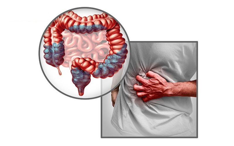 Viêm đại tràng co thắt: Nguyên nhân và giải pháp từ Đại tràng Á Âu