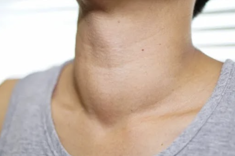 Nguyên nhân gây bướu cổ và cách cải thiện hiệu quả nhờ Ích Giáp Vương Platinum