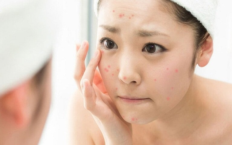 Da mặt bị nổi mẩn đỏ, ngứa là dấu hiệu điển hình của dị ứng