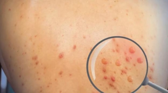 Tiền Giang phát hiện ca đậu mùa khỉ đầu tiên là một người làm vườn