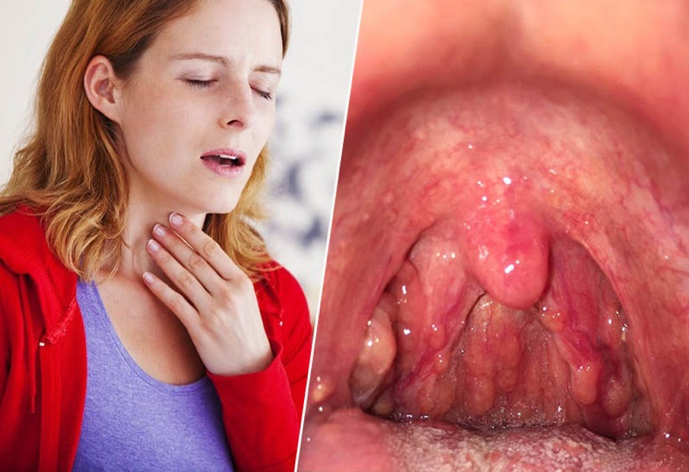 Đau rát họng là triệu chứng điển hình của bệnh viêm họng hạt