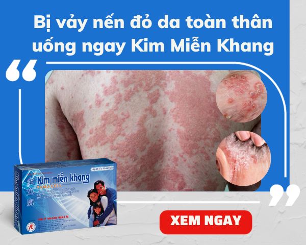 Tìm hiểu bệnh vảy nến đỏ da toàn thân và giải pháp từ Kim Miễn Khang