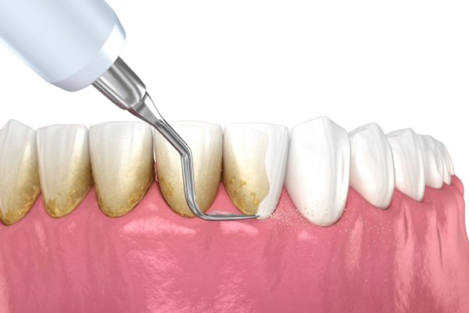 Loại bỏ cao răng khi vi&ecirc;m ch&acirc;n răng giai đoạn nhẹ