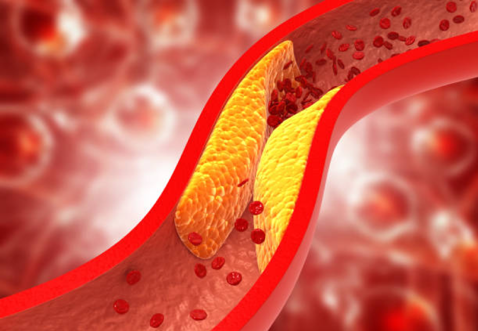 Mỡ máu cao tạo điều kiện hình thành các mảng xơ vữa làm hẹp lòng mạch