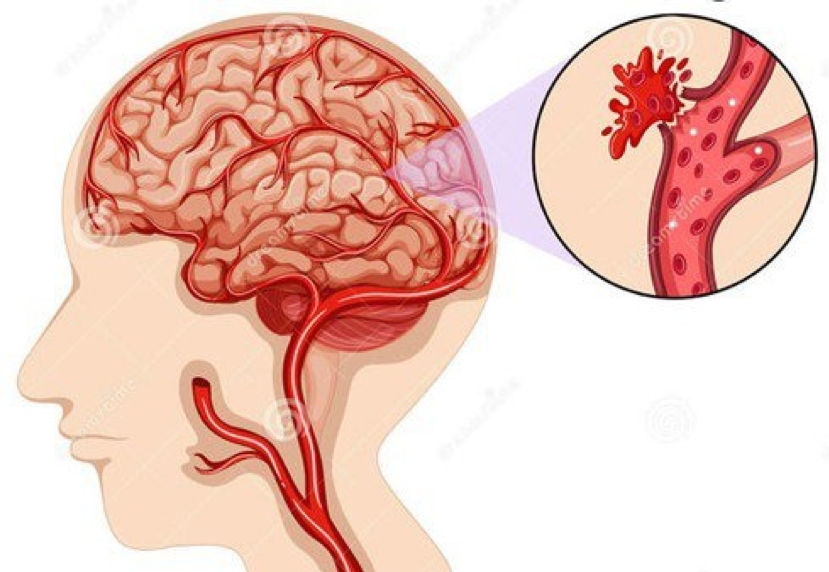 Đau nửa đầu sau gáy có thể xảy ra do tình trạng xuất huyết não