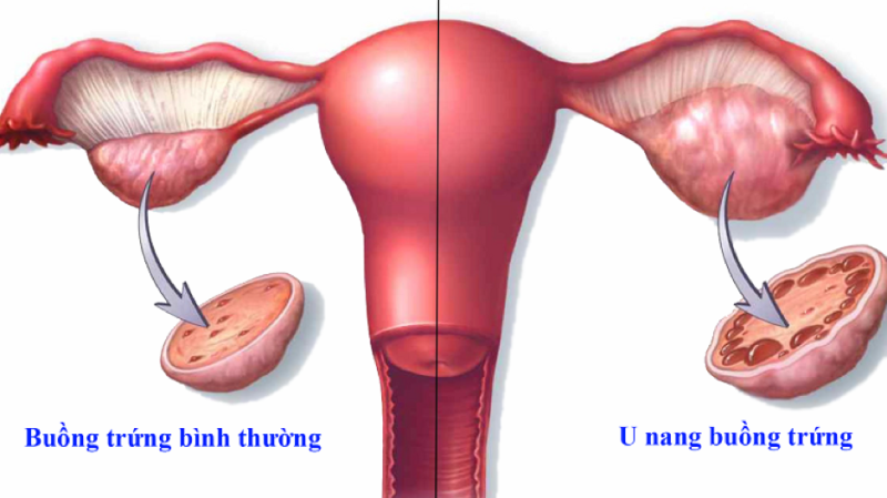 U nang buồng trứng là bệnh lý thường gặp ở phụ nữ độ tuổi sinh sản