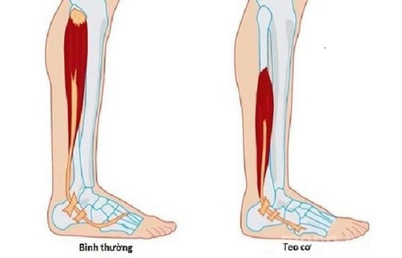 Viêm khớp ở giai đoạn nặng có thể gây biến chứng teo cơ