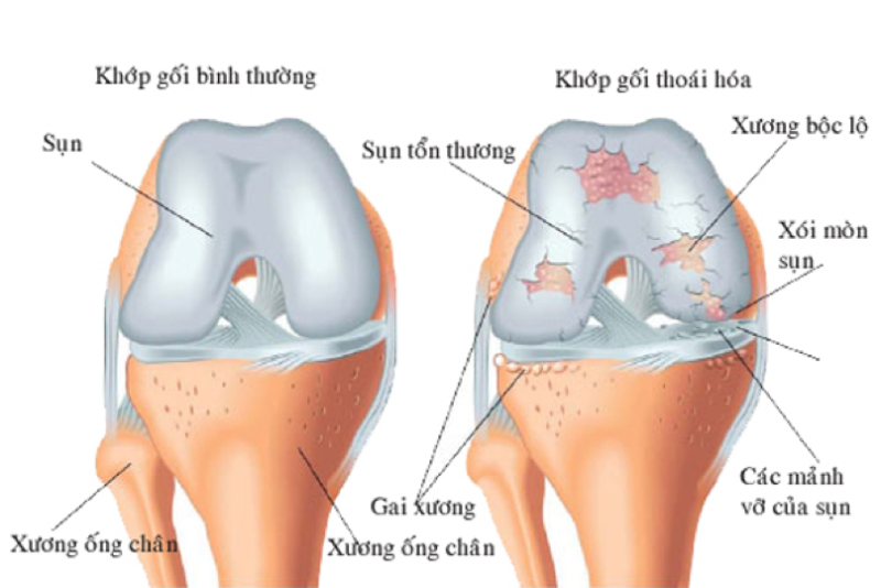 Tê mỏi vai gáy, chân tay là biểu hiện của thoái hóa khớp