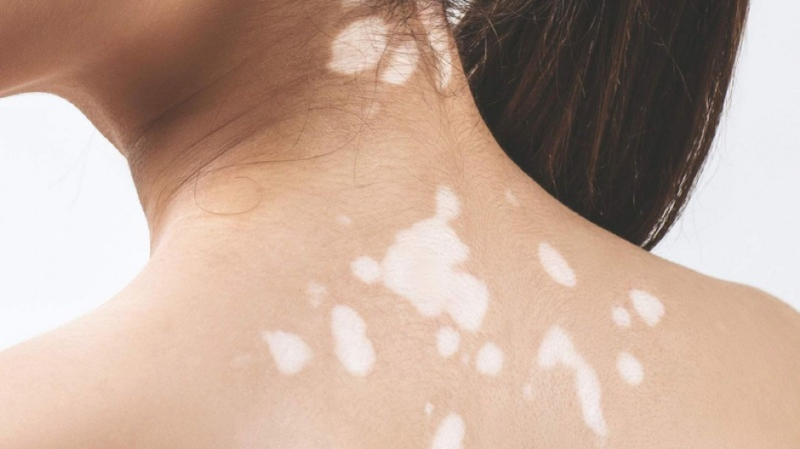 Vùng da bị bạch biến sẽ sáng màu hơn vùng da lành do mất sắc tố da