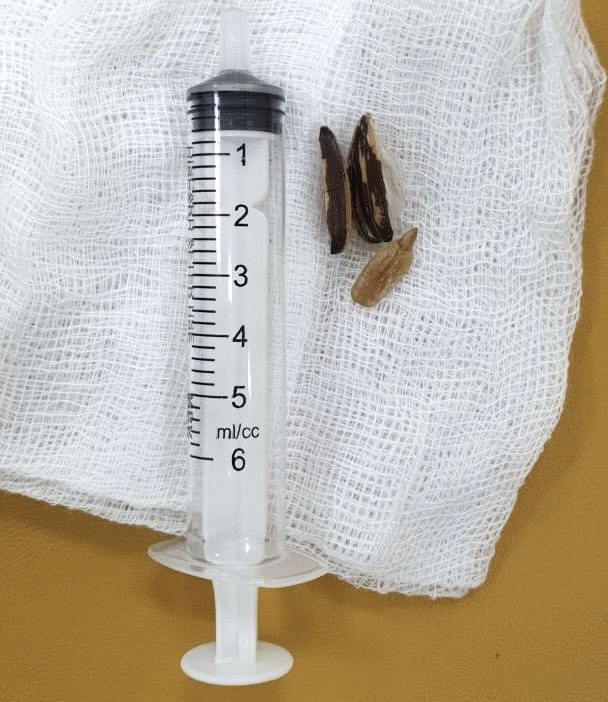 Cấp cứu kịp thời bé gái 2 tuổi hóc dị vật hạt hướng dương trong khí quản