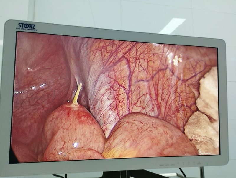 Hình ảnh bệnh nhân bị thủng ruột do nuốt phải tăm tre