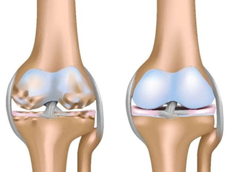 Kh&ocirc; khớp l&agrave; t&igrave;nh trạng bao hoạt dịch kh&ocirc;ng tiết ra đủ dịch nhầy b&ocirc;i trơn, sụn khớp dần bị b&agrave;o m&ograve;n