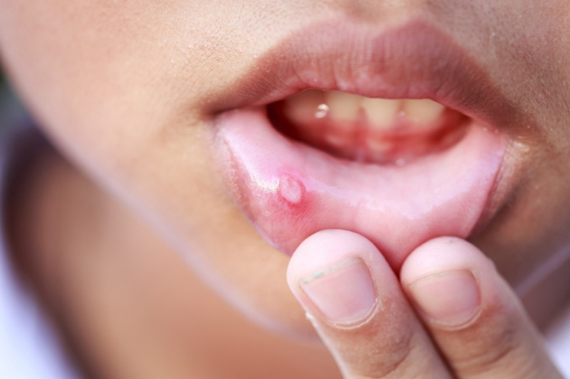 Vi khuẩn, virus là nguyên nhân chính gây nhiệt miệng tái phát thường xuyên