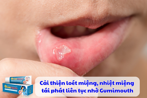 Cải thiện loét miệng, nhiệt miệng tái phát liên tục nhờ Gumimouth