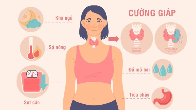 U tuyến giáp tăng sản xuất hormone gây ra các triệu chứng của cường giáp