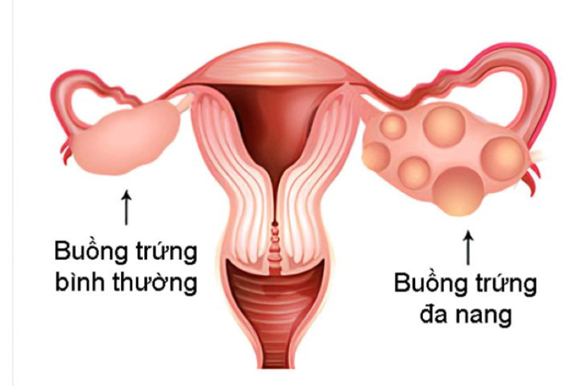 Đa nang buồng trứng là một bệnh lý thường gặp ở phụ nữ trong độ tuổi sinh nở